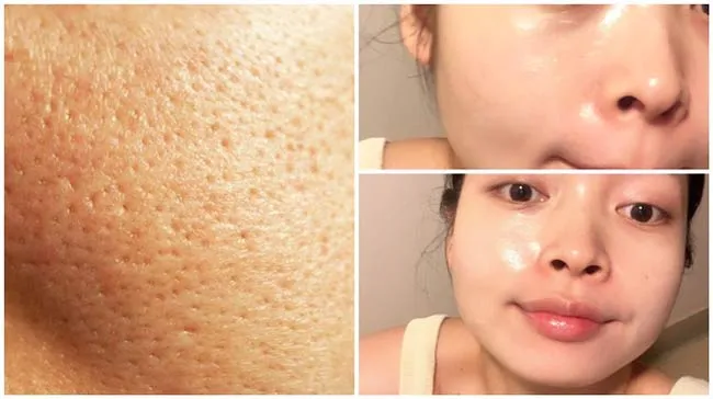 Top 19+ mặt nạ se khít lỗ chân lông cho da dầu nhờn hiệu quả