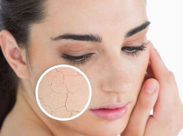 Review 6 kem hỗ trợ làm sạch mụn cho da khô chất lượng tốt mọi thời đại