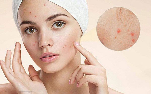 Review 6 kem hỗ trợ làm sạch mụn cho da khô chất lượng tốt mọi thời đại