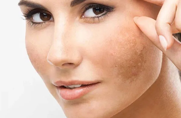 Nám là gì? Top 9 serum trị nám da hiệu quả hiện nay - 2