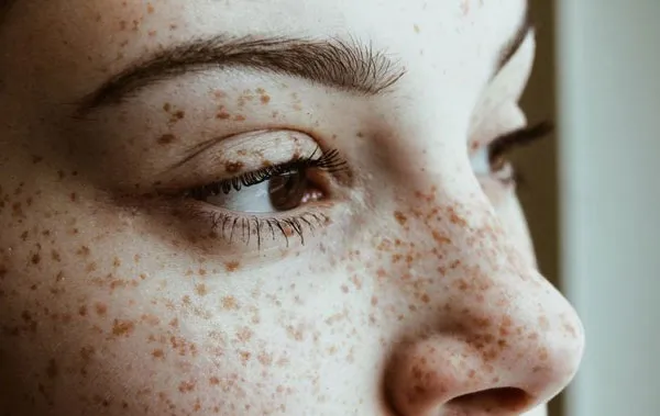 Nám là gì? Top 9 serum trị nám da hiệu quả hiện nay - 3