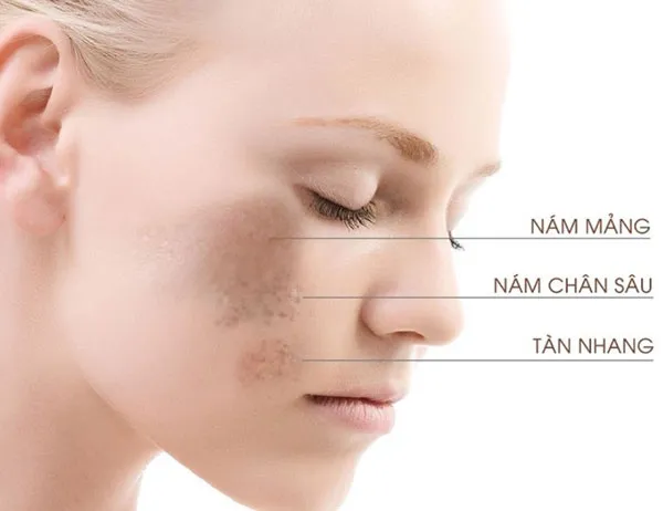 Nám là gì? Top 9 serum trị nám da hiệu quả hiện nay - 4