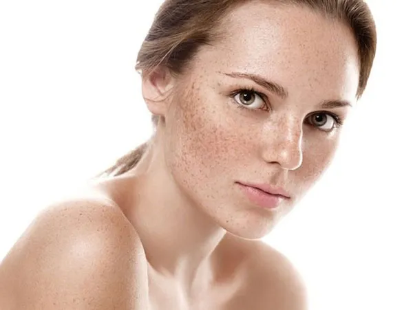 Nám là gì? Top 9 serum trị nám da hiệu quả hiện nay - 5