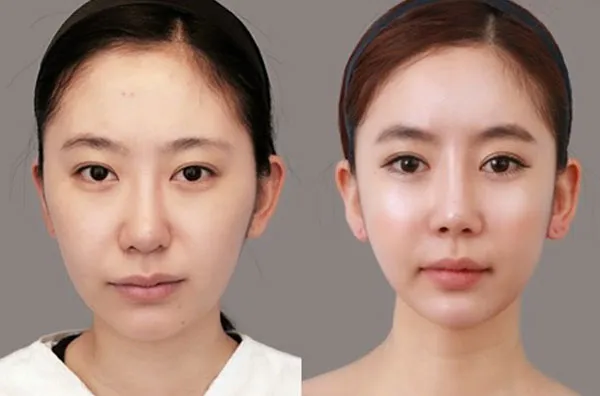 Nọng cằm là gì? Hướng dẫn 4 cách giảm nọng cằm tại nhà nhanh chỉ sau 1 tuần