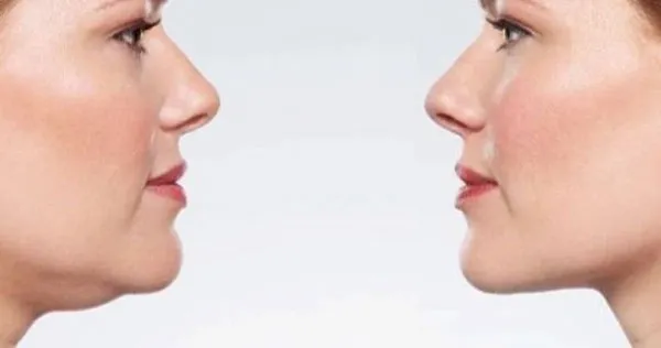 Nọng cằm là gì? Hướng dẫn 4 cách giảm nọng cằm tại nhà nhanh chỉ sau 1 tuần