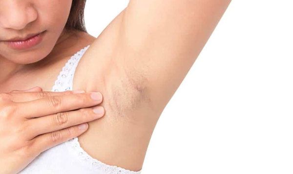 Top 15 Cách trị thâm nách tại nhà đơn giản và hiệu quả chỉ sau 5 ngày