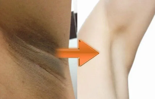 Top 15 Cách trị thâm nách tại nhà đơn giản và hiệu quả chỉ sau 5 ngày