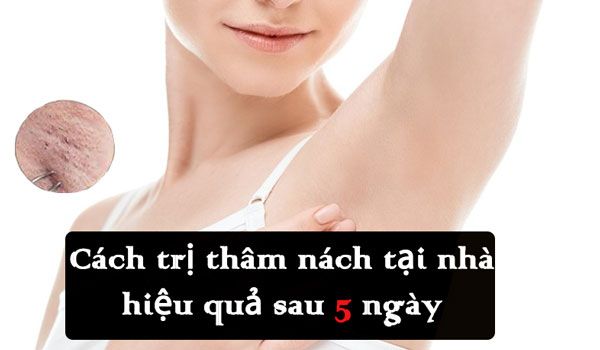 Top 15 Cách trị thâm nách tại nhà đơn giản và hiệu quả chỉ sau 5 ngày