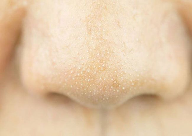 Mụn cám là gì? Top 5 sản phẩm trị sạch mụn cám thân thiện với làn da và nhanh chóng