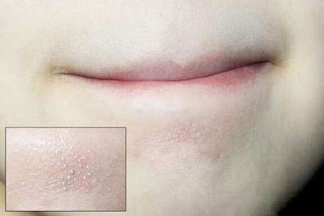 Mụn cám là gì? Top 5 sản phẩm trị sạch mụn cám thân thiện với làn da và nhanh chóng