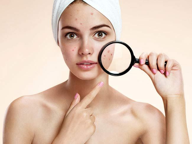Mụn trứng cá là gì? Review 9 mỹ phẩm hỗ trợ làm sạch mụn trứng cá hiệu quả