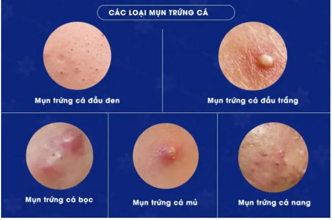 Mụn trứng cá là gì? Review 9 mỹ phẩm hỗ trợ làm sạch mụn trứng cá hiệu quả