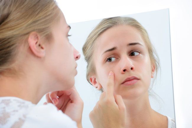 Mụn trứng cá là gì? Review 9 mỹ phẩm hỗ trợ làm sạch mụn trứng cá hiệu quả