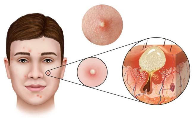 Mụn trứng cá là gì? Review 9 mỹ phẩm hỗ trợ làm sạch mụn trứng cá hiệu quả