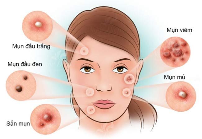 Mụn trứng cá là gì? Review 9 mỹ phẩm hỗ trợ làm sạch mụn trứng cá hiệu quả