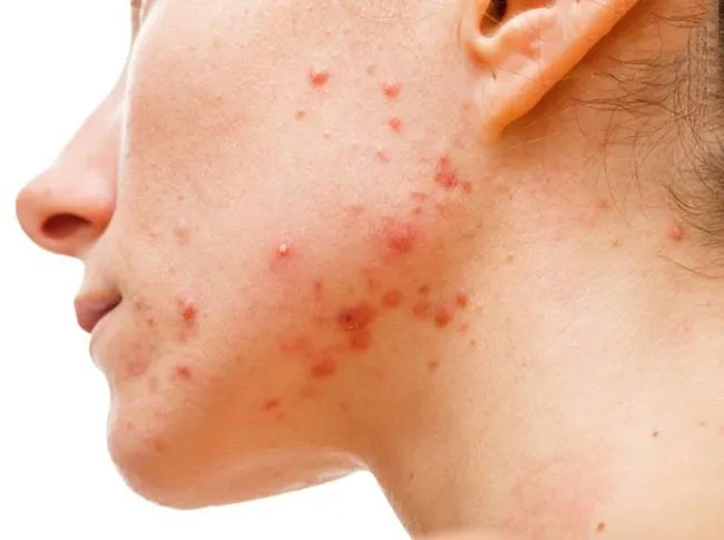 11 sản phẩm hỗ trợ hỗ trợ cải thiện mụn viêm hiệu quả được yêu thích hiện nay - 1