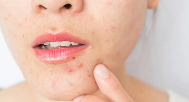 11 sản phẩm hỗ trợ hỗ trợ cải thiện mụn viêm hiệu quả được yêu thích hiện nay - 2