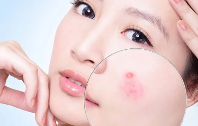 11 sản phẩm hỗ trợ hỗ trợ cải thiện mụn viêm hiệu quả được yêu thích hiện nay - 3