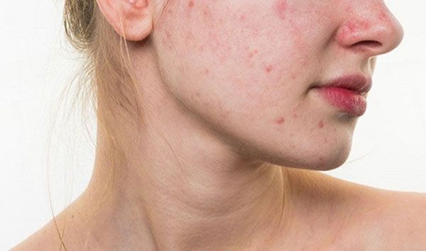Benzoyl Peroxide là gì? Dùng Benzoyl Peroxide hỗ trợ làm sạch mụn có thực sự tốt hay không?