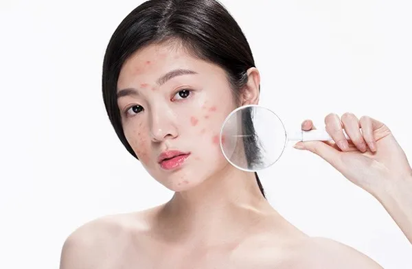 Benzoyl Peroxide là gì? Dùng Benzoyl Peroxide hỗ trợ làm sạch mụn có thực sự tốt hay không?