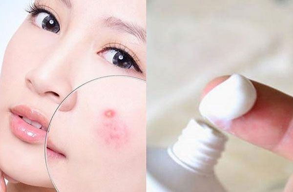 Benzoyl Peroxide là gì? Dùng Benzoyl Peroxide hỗ trợ làm sạch mụn có thực sự tốt hay không?