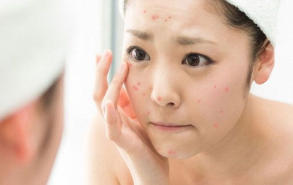 Benzoyl Peroxide là gì? Dùng Benzoyl Peroxide hỗ trợ làm sạch mụn có thực sự tốt hay không?