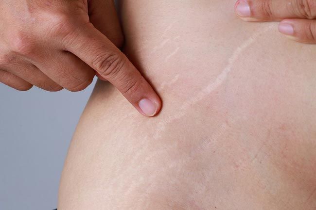 Top 5 sản phẩm trị rạn da giảm thâm hiệu quả và rất thân thiện với làn da