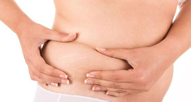Top 5 sản phẩm trị rạn da giảm thâm hiệu quả và rất thân thiện với làn da