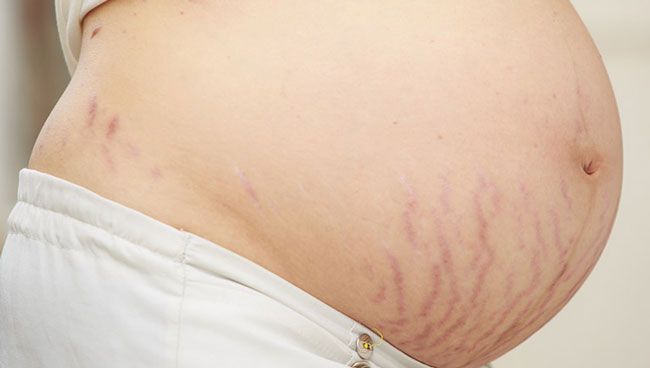 Top 5 sản phẩm trị rạn da giảm thâm hiệu quả và rất thân thiện với làn da