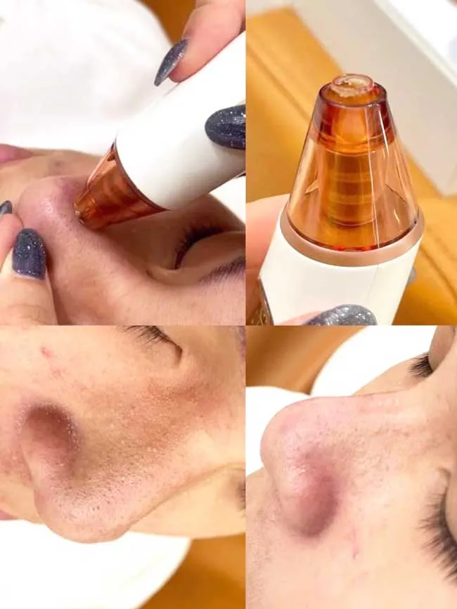 Review máy hút mụn Juvera sạch mụn đầu đen bã nhờn tại nhà - 9