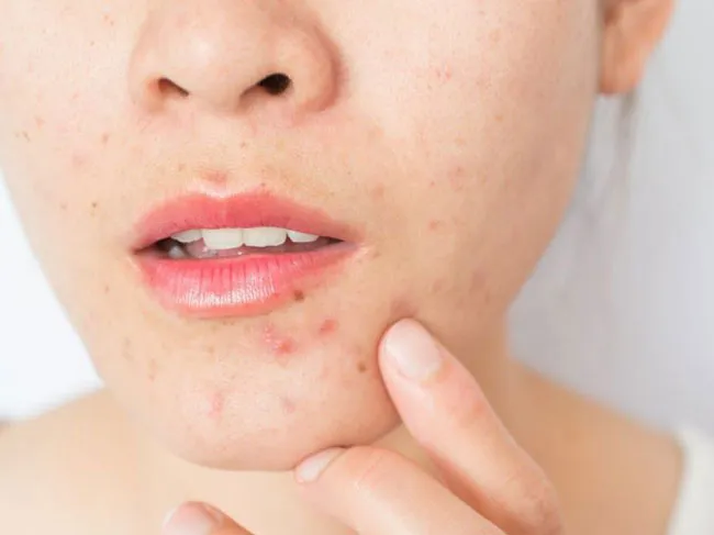 Salicylic acid là gì? Công dụng và cách dùng trong làm đẹp