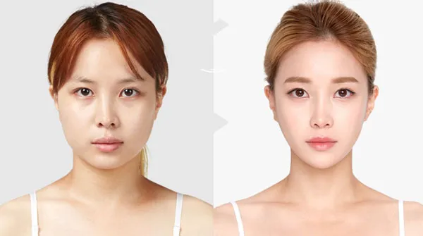 Nâng cơ mặt bằng sóng RF có tốt không? Review 6 máy nâng cơ sóng RF chất lượng tốt - 2