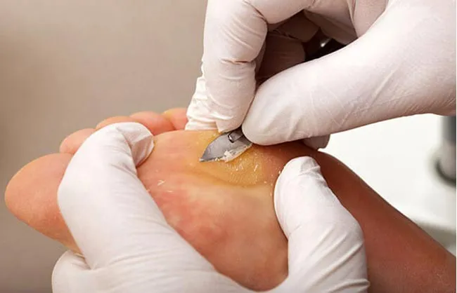 13 phương pháp hỗ trợ làm sạch mụn cóc hiệu quả và thân thiện với làn da