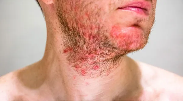 12 cách chữa viêm nang lông nhẹ tại nhà hiệu quả và tiết kiệm