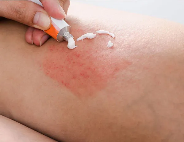 12 cách chữa viêm nang lông nhẹ tại nhà hiệu quả và tiết kiệm