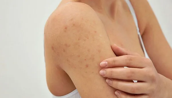 12 cách chữa viêm nang lông nhẹ tại nhà hiệu quả và tiết kiệm