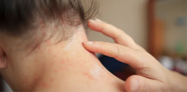 12 cách chữa viêm nang lông nhẹ tại nhà hiệu quả và tiết kiệm