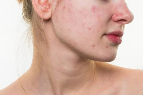 Da bị nhiễm corticoid là gì? 7 cách phục hồi da nhiễm corticoid từ nhẹ đến nặng