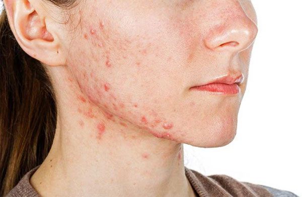 Da bị nhiễm corticoid là gì? 7 cách phục hồi da nhiễm corticoid từ nhẹ đến nặng