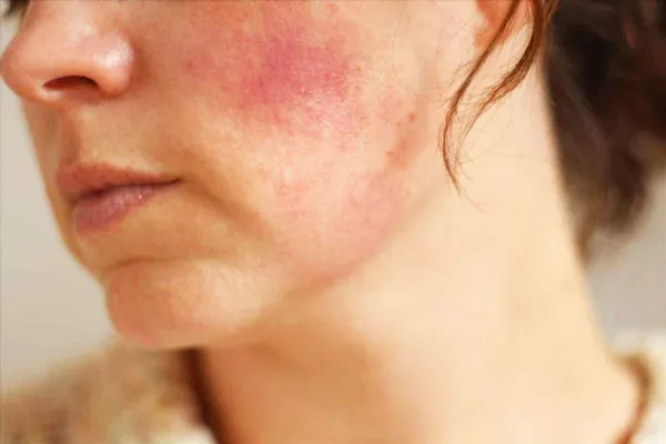 Da bị nhiễm corticoid là gì? 7 cách phục hồi da nhiễm corticoid từ nhẹ đến nặng