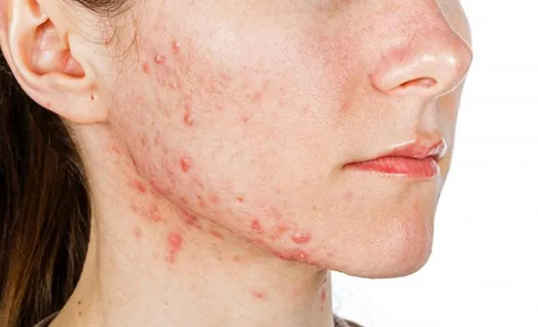 kem hỗ trợ làm sạch mụn tuổi dậy thì nữ 3