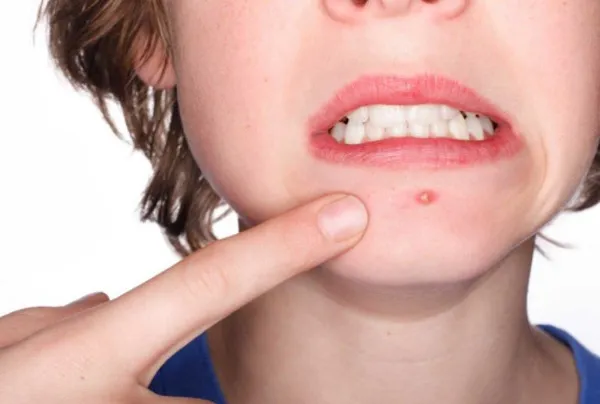 kem hỗ trợ làm sạch mụn tuổi dậy thì nữ 4