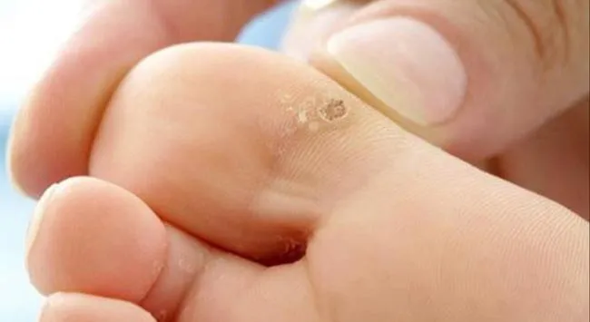 13 phương pháp hỗ trợ làm sạch mụn cóc hiệu quả và thân thiện với làn da