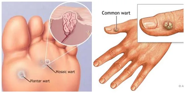 13 phương pháp hỗ trợ làm sạch mụn cóc hiệu quả và thân thiện với làn da
