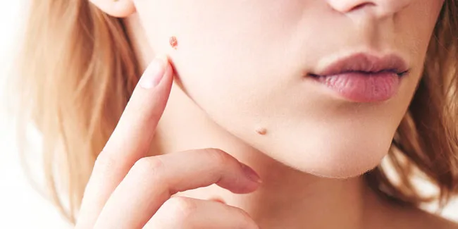 13 phương pháp hỗ trợ làm sạch mụn cóc hiệu quả và thân thiện với làn da