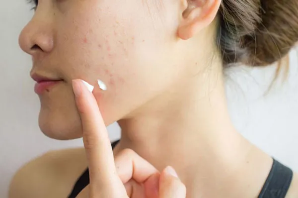 Top 15 sữa rửa mặt hỗ trợ làm sạch mụn chất lượng tốt dùng hiệu quả cho mọi loại da - 3