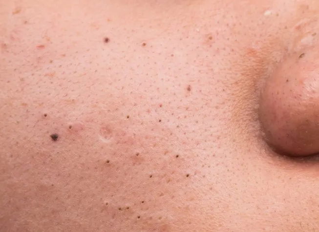 10 cách nhận diện các loại mụn trên khuôn mặt bạn nên biết
