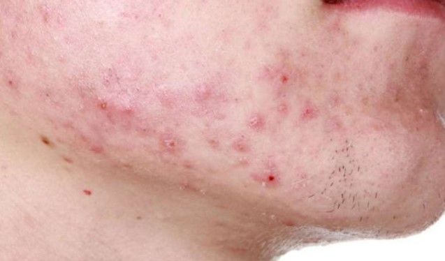 10 cách nhận diện các loại mụn trên khuôn mặt bạn nên biết