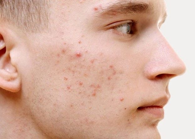 10 cách nhận diện các loại mụn trên khuôn mặt bạn nên biết