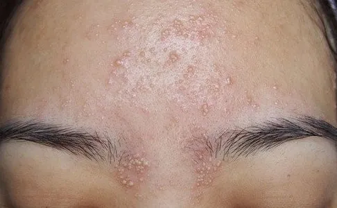 10 cách nhận diện các loại mụn trên khuôn mặt bạn nên biết